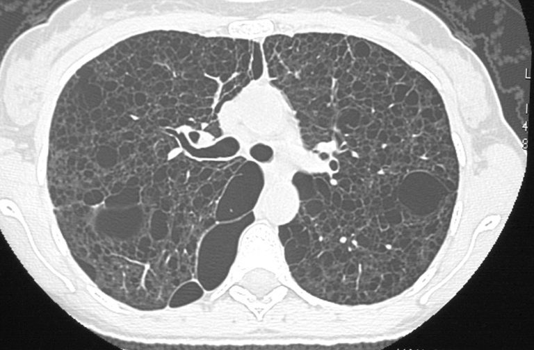 000 Cysts in the Lung | Lungs