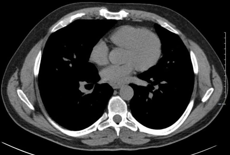 026Lu Sarcoidosis Diffuse Ground Glass Stable 9 years | Lungs