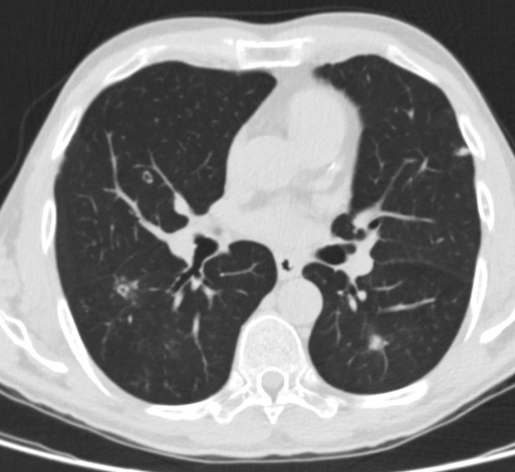 041Lu Laryngotracheobronchial Papillomatosis | Lungs