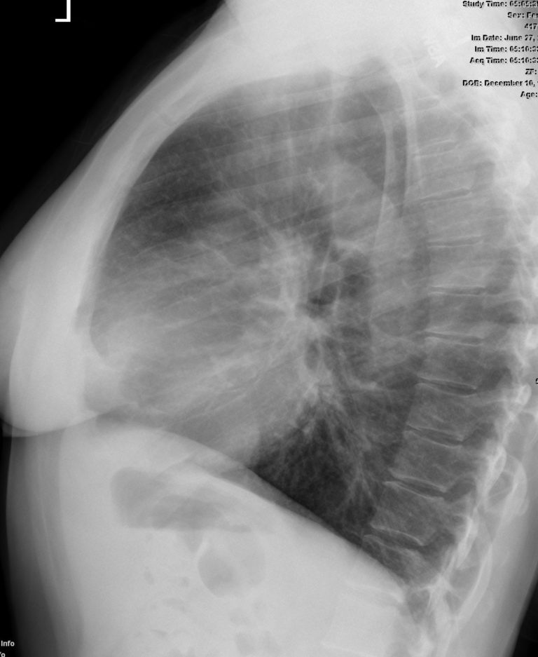 035Lu Emphysema in 49F | Lungs