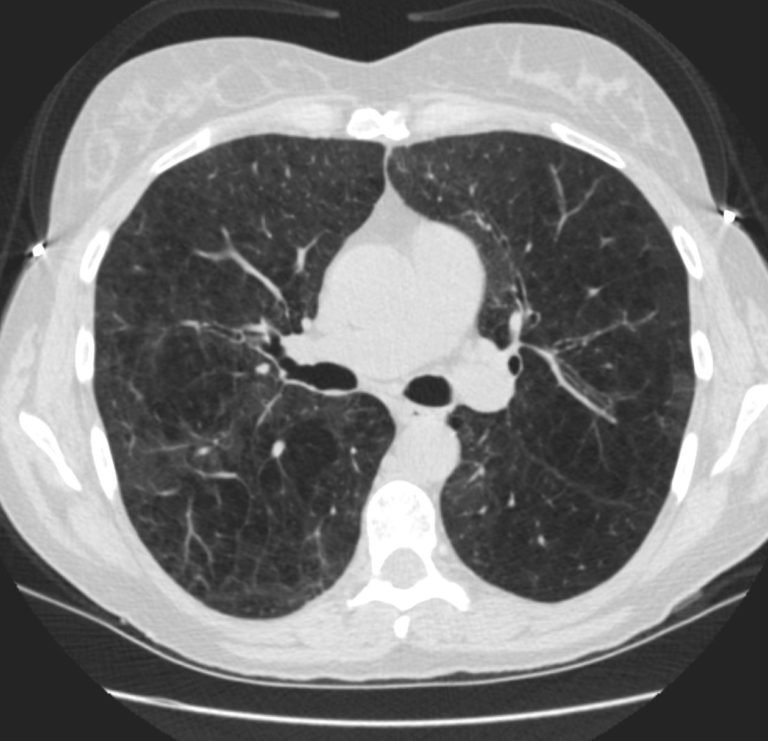 035Lu Emphysema in 49F | Lungs