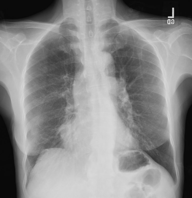 Emphysema Cystic type | Lungs