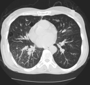 Emphysema Cystic type | Lungs