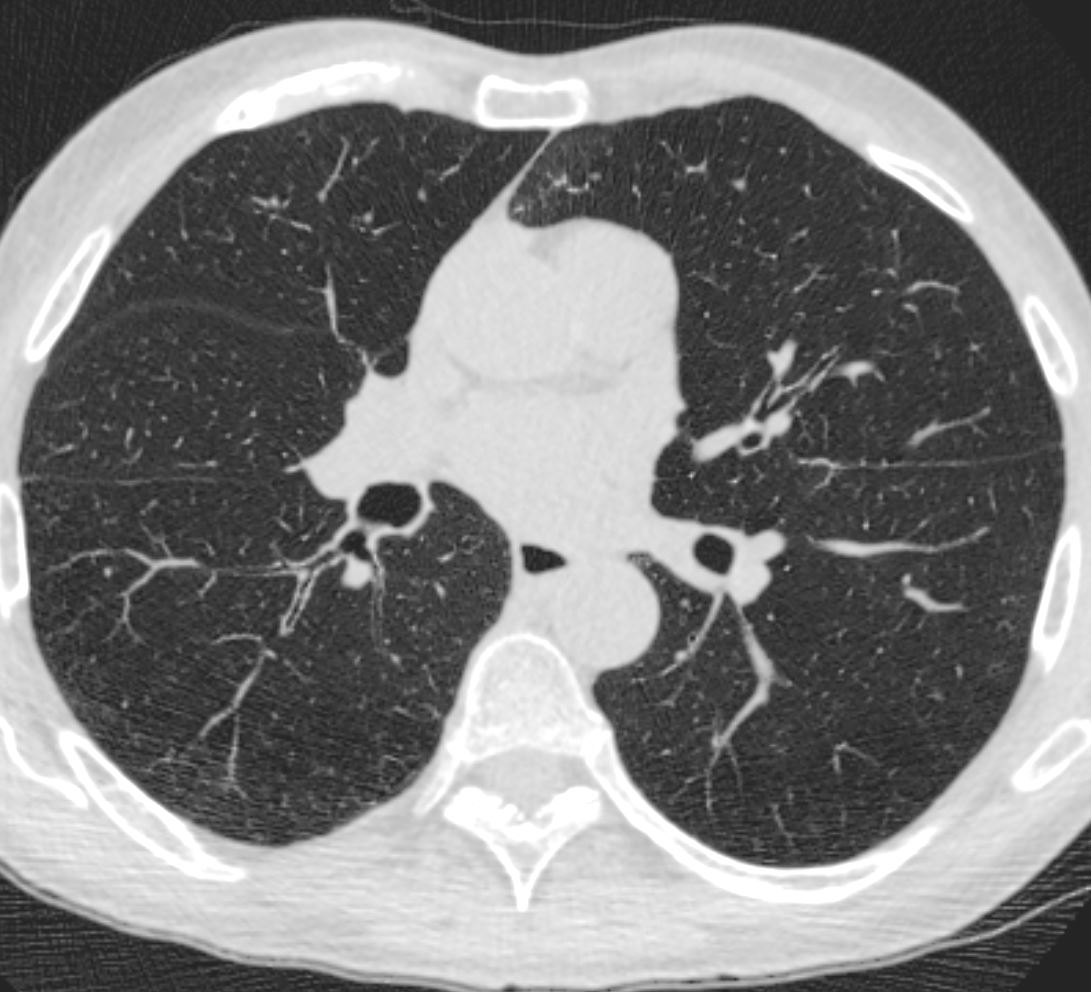 030Lu Emphysema and Bronchitis | Lungs