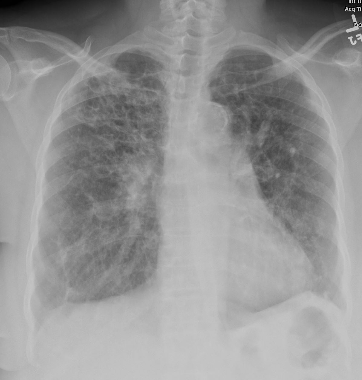 Chest CT Signs in Pulmonary Disease: A Pictorial Review