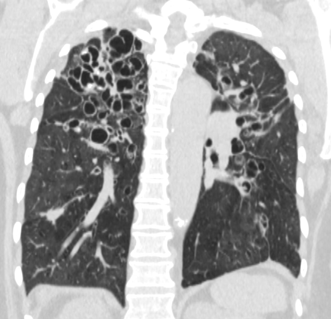 032Lu Bronchiectasis and Emphysema | Lungs