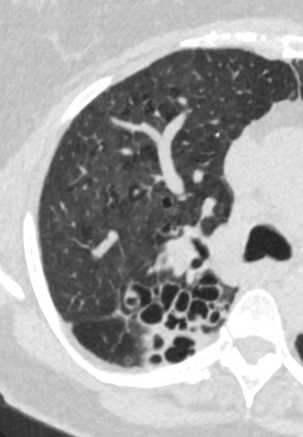 Spectrum of High Resolution Computed Tomography Findings in Occupational Lung  Disease: Experience in a Tertiary Care Institute - Journal of Clinical  Imaging Science