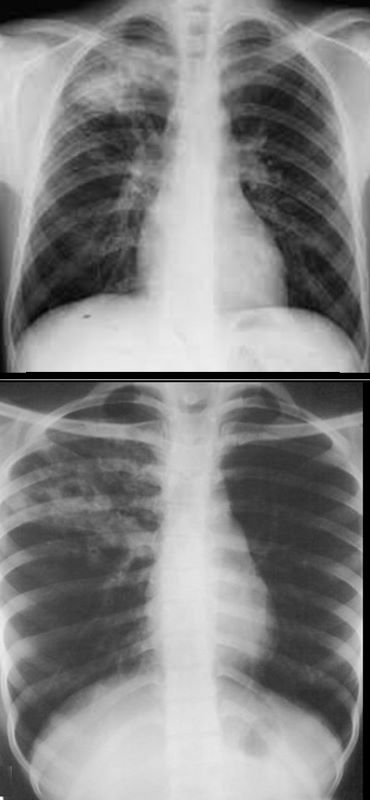 TB Ghon Focus | Lungs