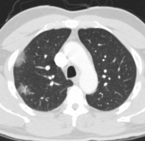 Ground Glass Associated Diseases | Lungs