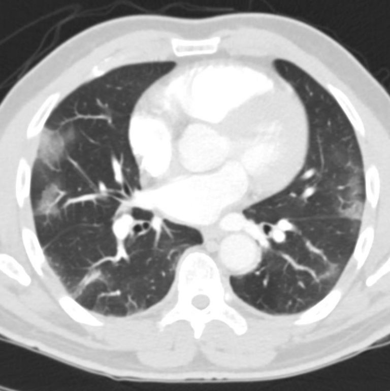 Nodules Infectious Inflammatory | Lungs