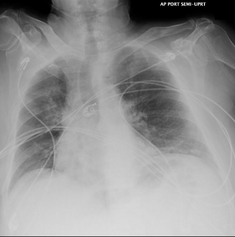 046Lu Covid 19 Confluent GGO Infiltrate | Lungs