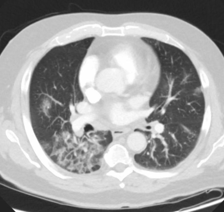 046Lu Covid 19 Confluent GGO Infiltrate | Lungs