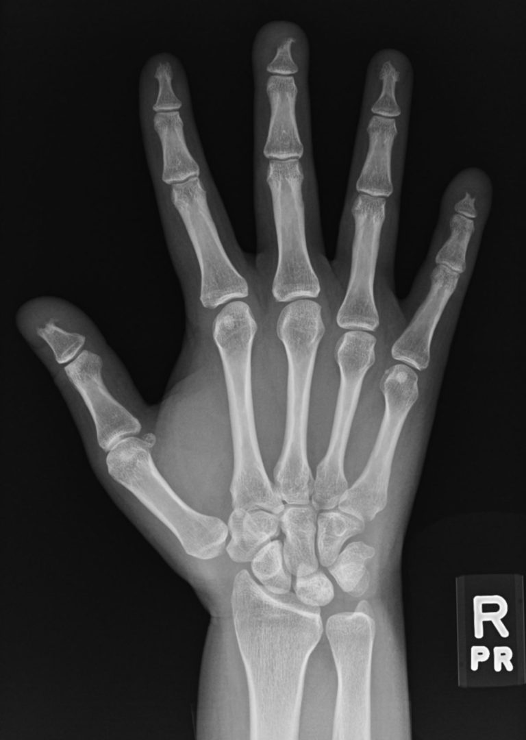 050Lu Scleroderma NSIP Acro-osteolysis | Lungs