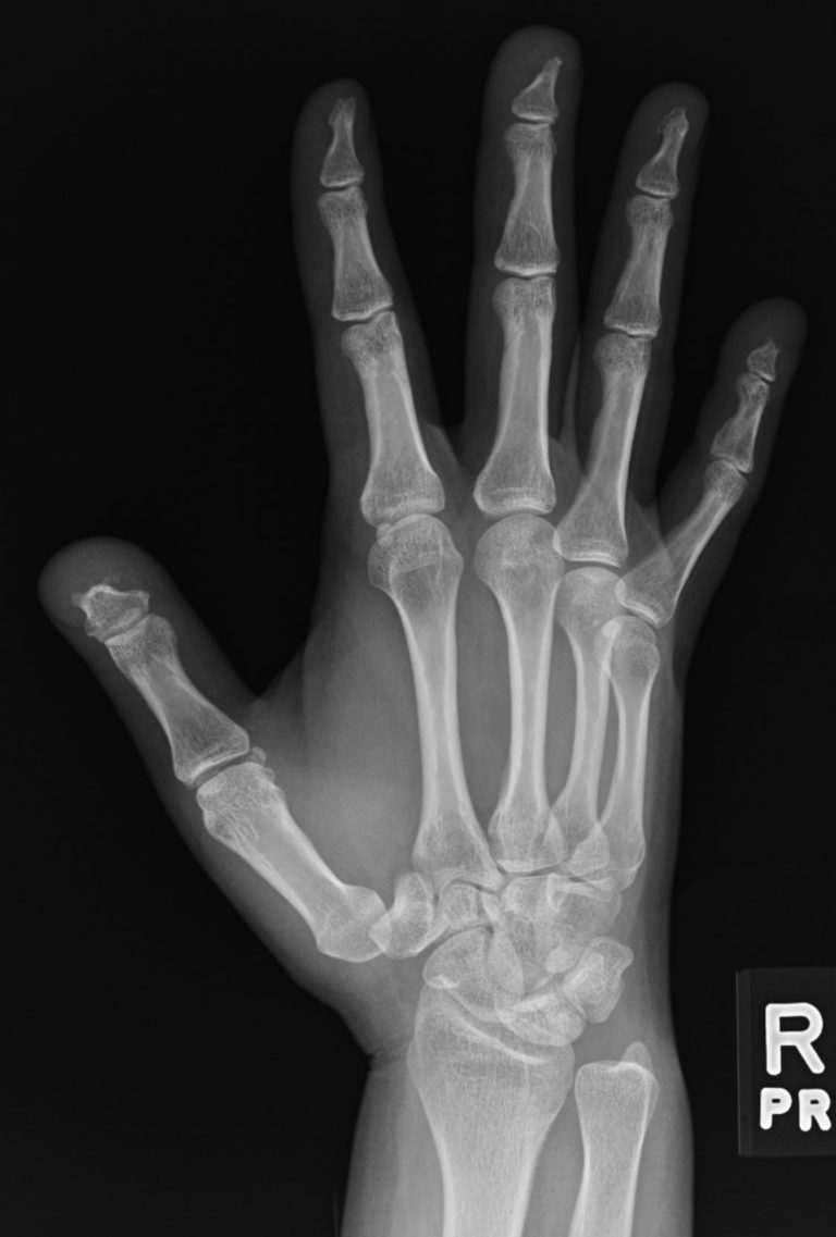 050Lu Scleroderma NSIP Acro-osteolysis | Lungs