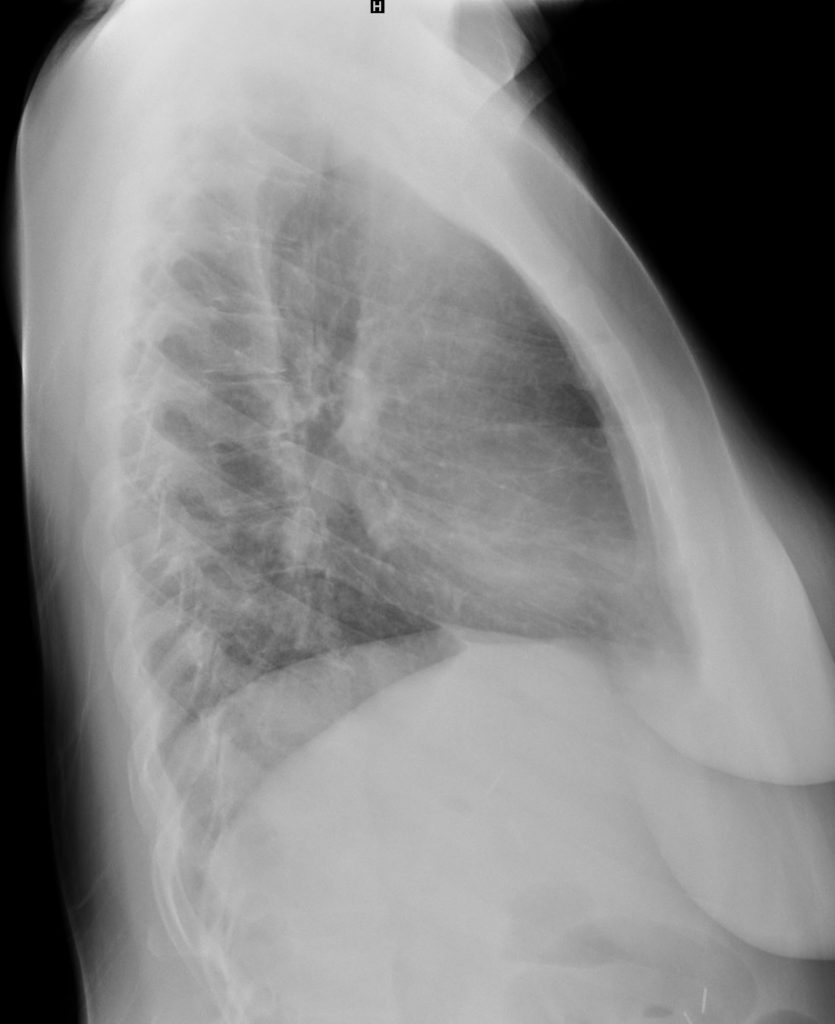 050Lu Scleroderma NSIP Acro-osteolysis | Lungs