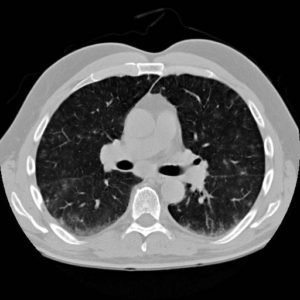 Amiodarone Toxicity | Lungs