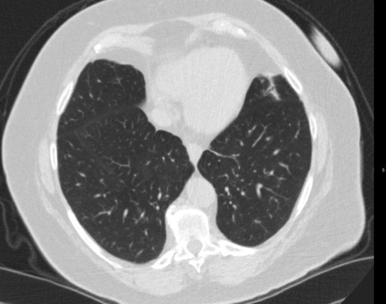 Emphysema Hyperinflation – Effects on the Mediastinum | Lungs