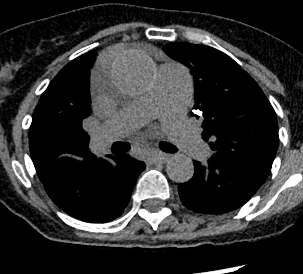 064 Sjogrens UIP LIP Calcified Cysts ILD | Lungs