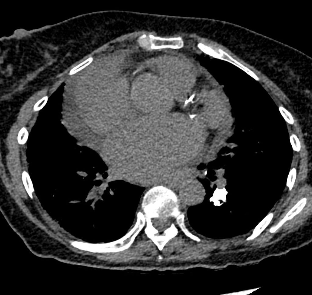 064 Sjogrens UIP LIP Calcified Cysts ILD | Lungs