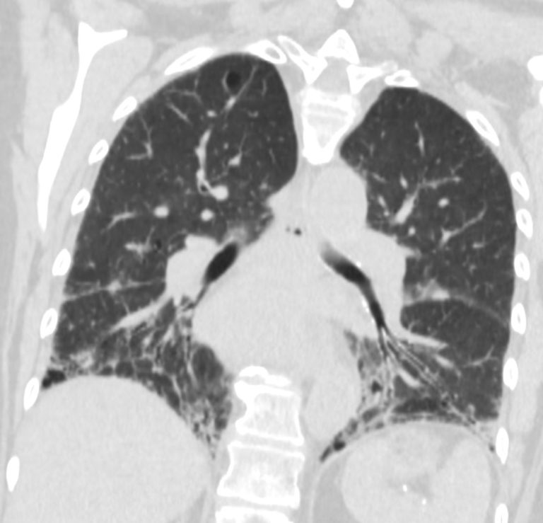 064 Sjogrens UIP LIP Calcified Cysts ILD | Lungs