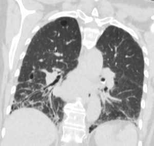 064 Sjogrens UIP LIP Calcified Cysts ILD | Lungs