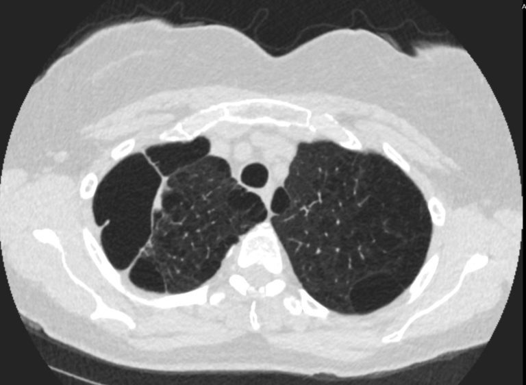 Emphysema Paraseptal Emphysema Lungs 0061