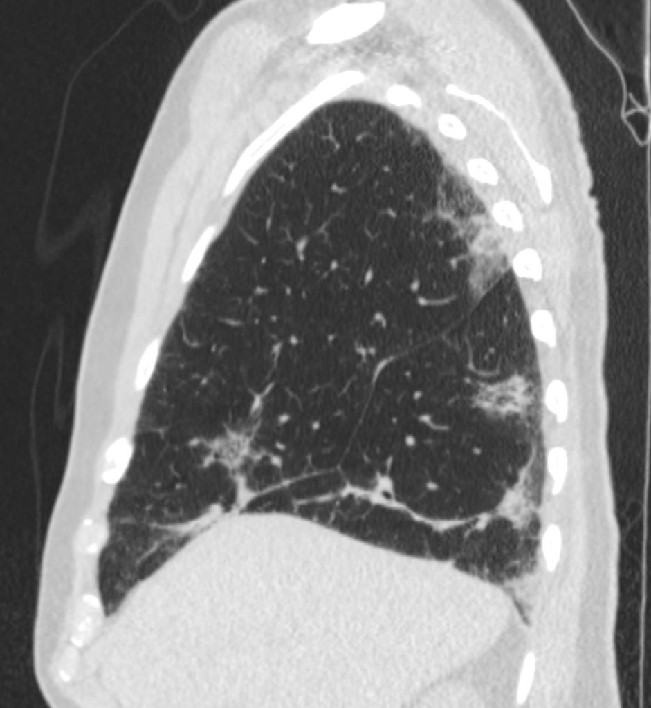 060LU COVID Complicated by Organizing Pneumonia OP | Lungs