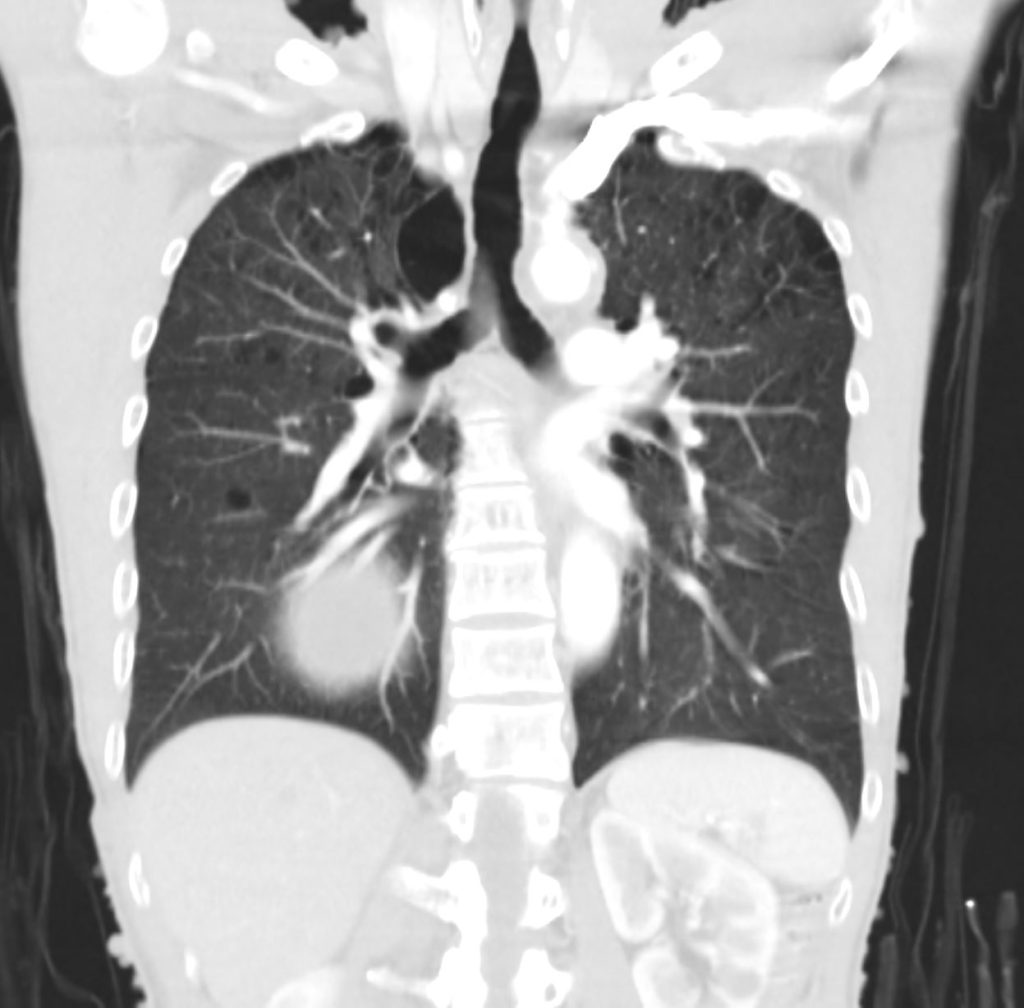 061lu Neurofibromatosis And Emphysema 