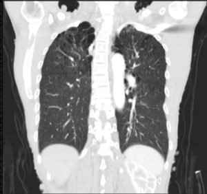 Upper Lobes and Centrilobular Emphysema | Lungs