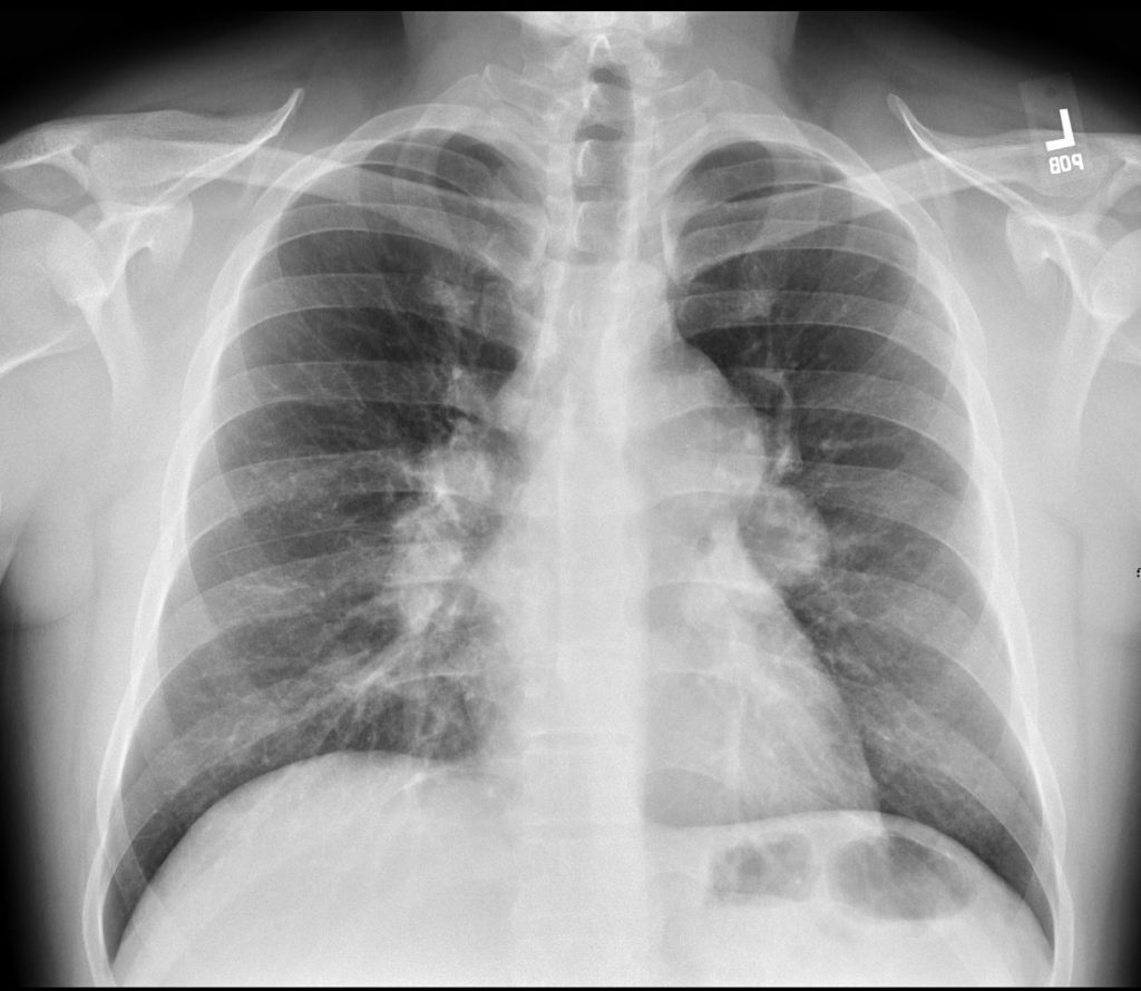 058LU Sarcoidosis Stage I to Stage 2 in 3 years | Lungs