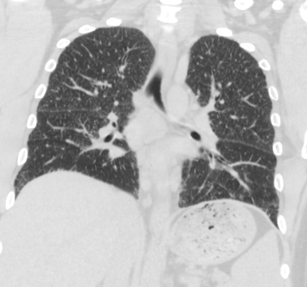 058LU Sarcoidosis Stage I to Stage 2 in 3 years | Lungs