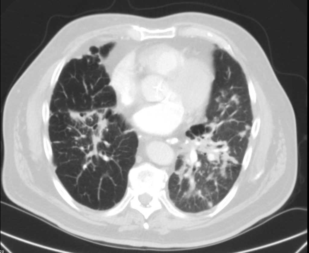 063Lu Sarcoidosis with Bronchiectasis | Lungs