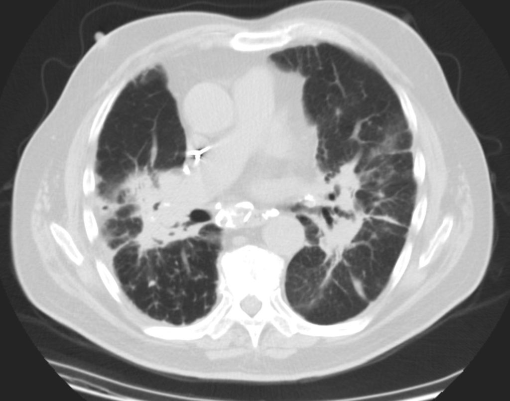 Sarcoidosis – Nodules and Micronodules | Lungs