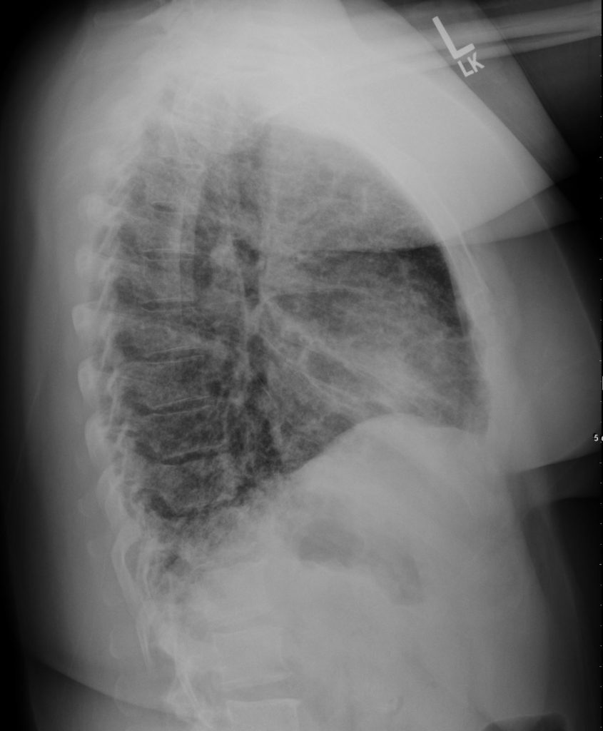 071Lu Acute Diffuse Sarcoidosis | Lungs