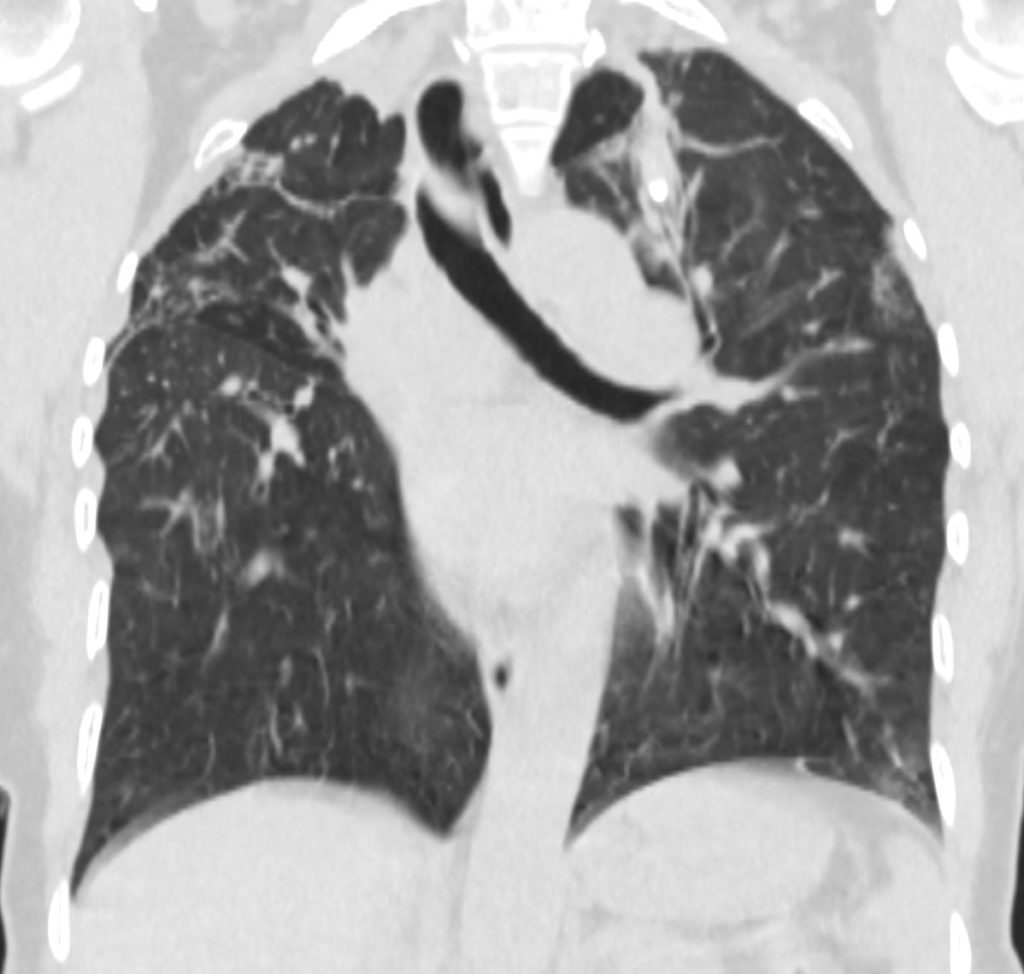 072LU TB and Bronchiectasis | Lungs