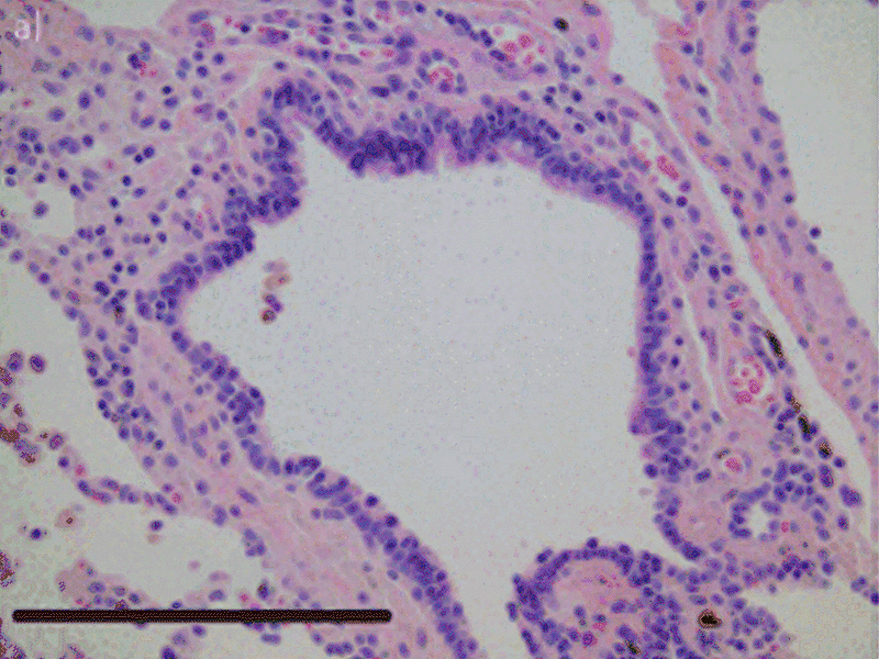 atelectasis histology