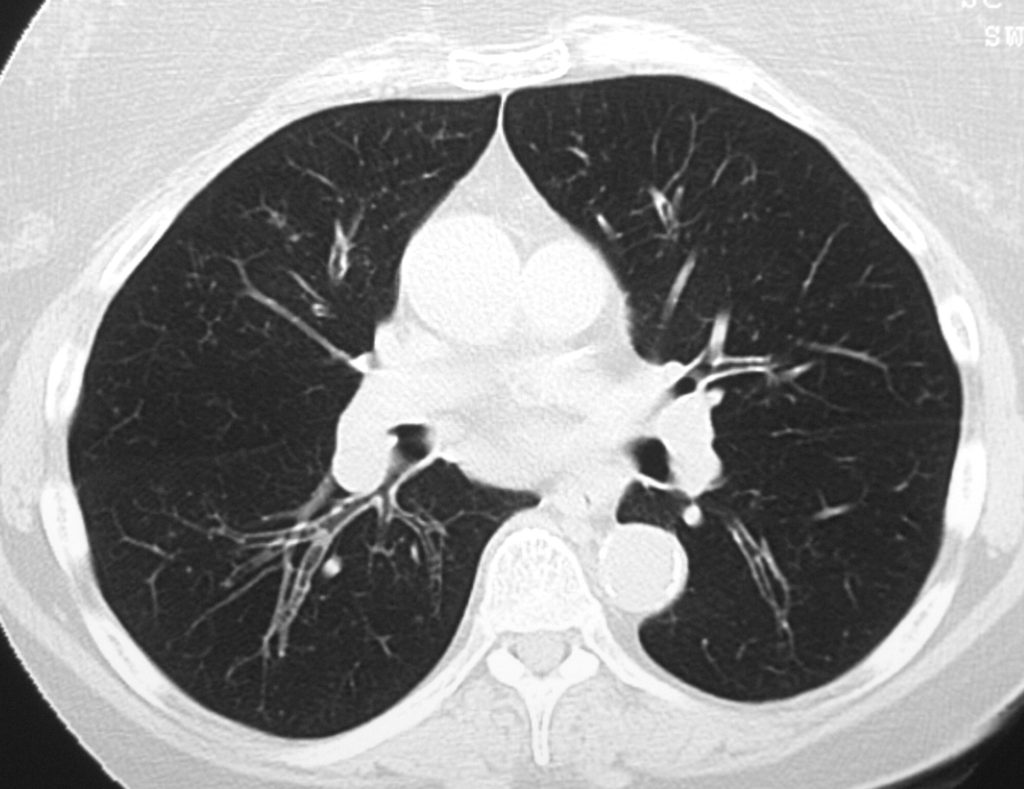 Chronic Bronchitis | Lungs