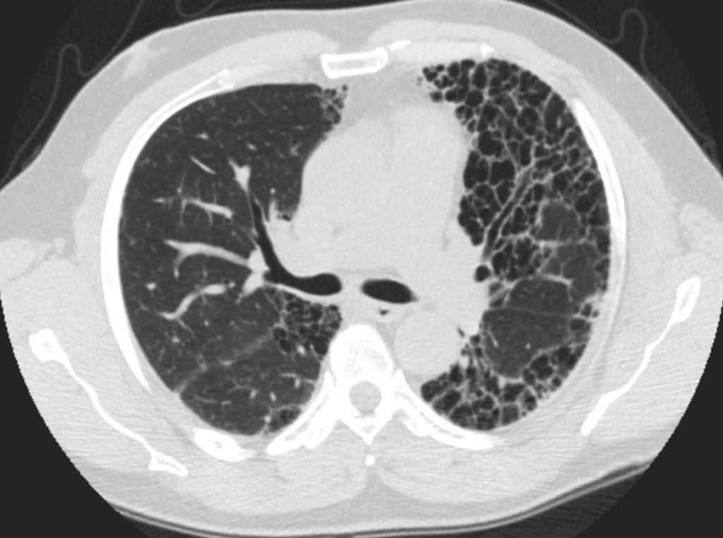 086Lu 57M Honeycomb ILD | Lungs