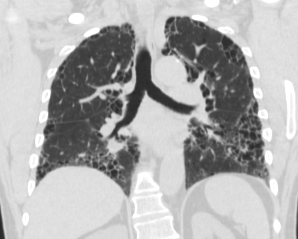 086Lu 57M Honeycomb ILD | Lungs