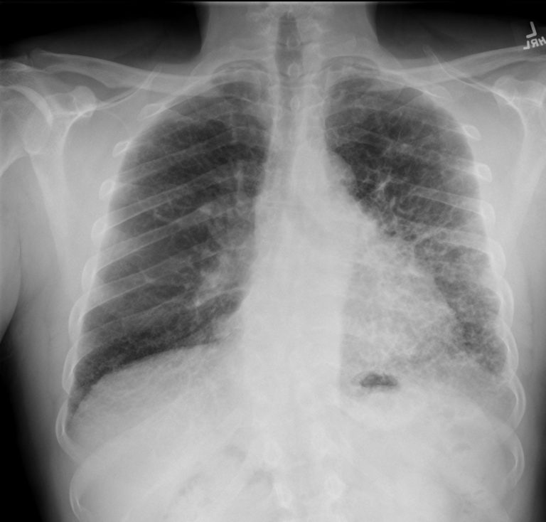 086Lu 57M Honeycomb ILD | Lungs