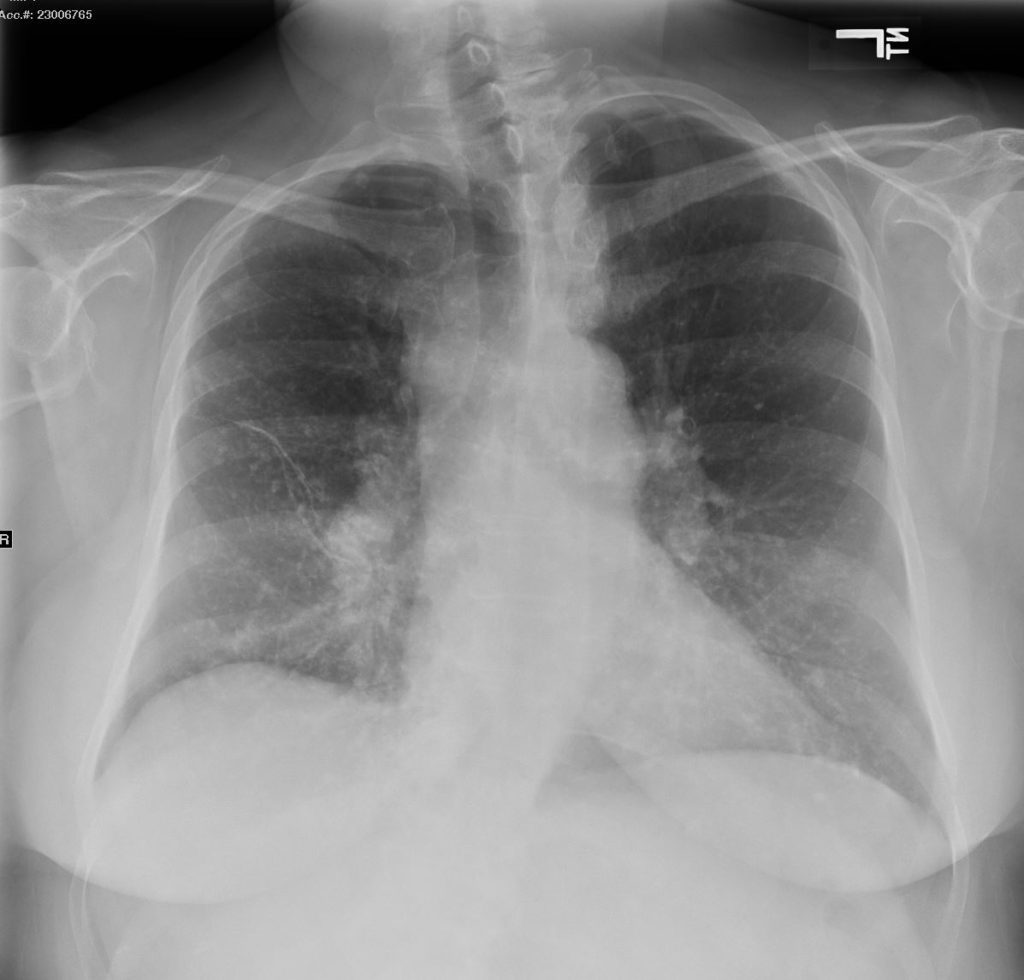 Faces of Amyloidosis | Lungs