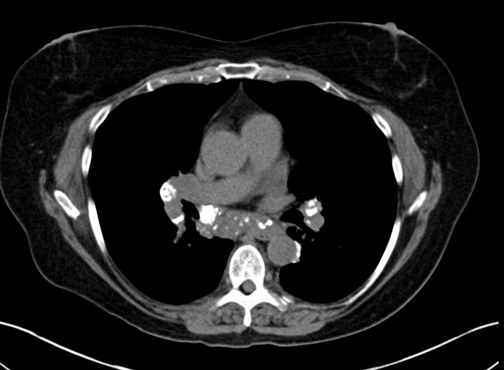 Faces of Calcified Mediastinal Nodes | Lungs