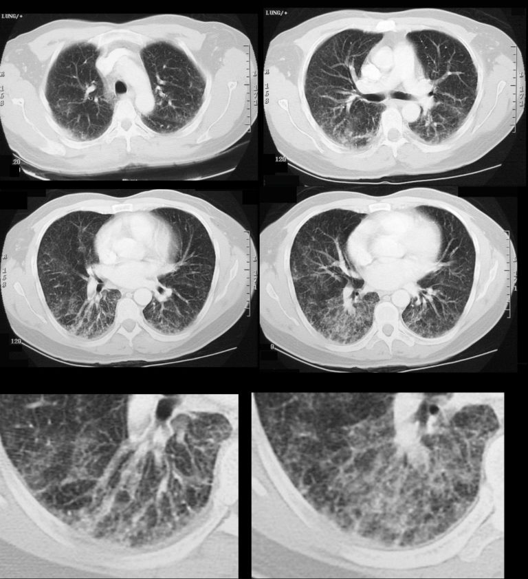 000 Reticular Pattern Reticulation | Lungs