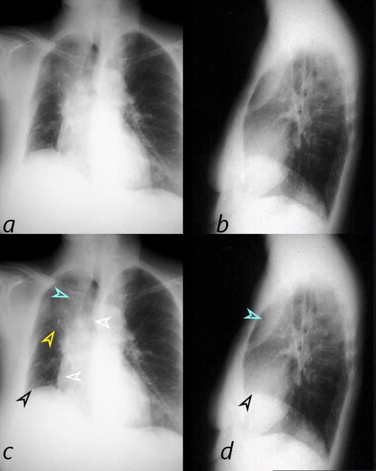 Radiological manifestations of thoracic hydatid cysts: pulmonary and  extrapulmonary findings | Insights into Imaging | Full Text