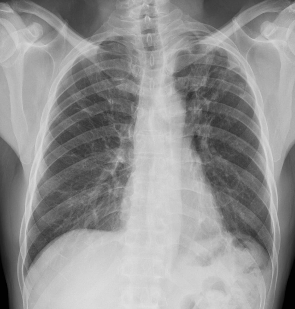 100Lu Chronic TB | Lungs