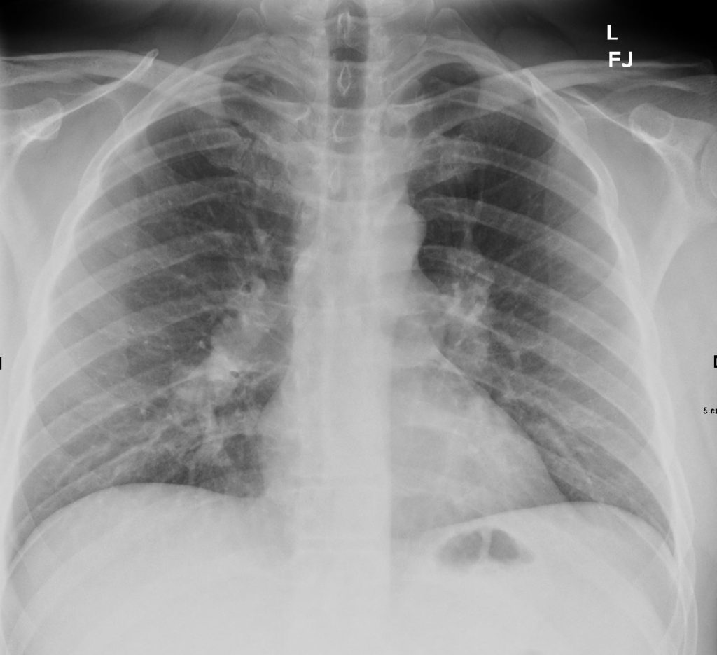 101Lu Sarcoid Stage 1 | Lungs