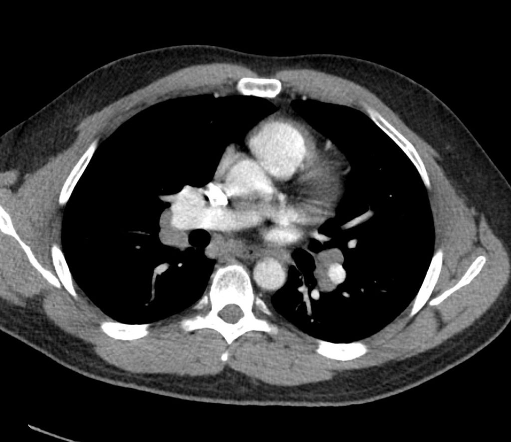 101Lu Sarcoid Stage 1 | Lungs