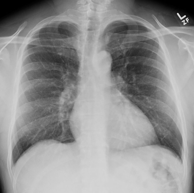 115Lu Central Squamous Cell Carcinoma with SVC Obstruction | Lungs