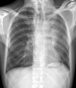 120 Lu Left Upper Lobe Collapse Cancer Luftschissel Sign | Lungs