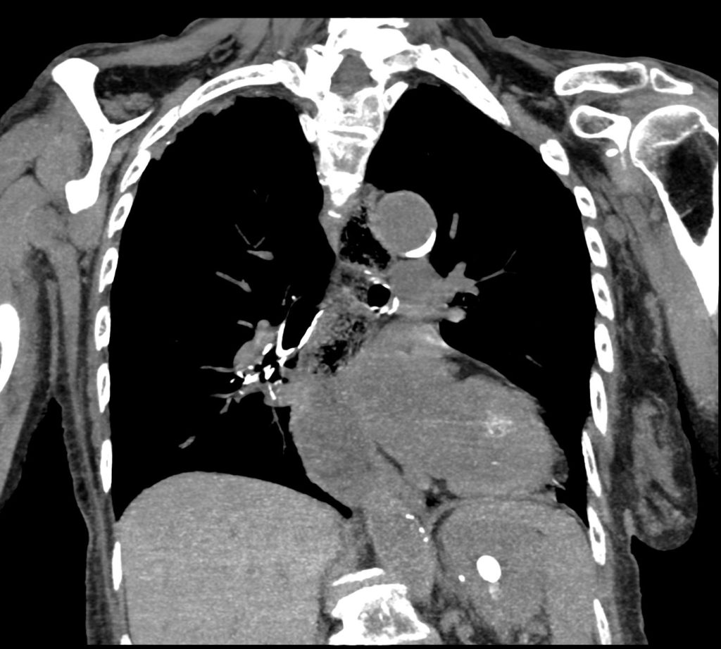 118Lu Scleroderma and Aspiration Pneumonia | Lungs